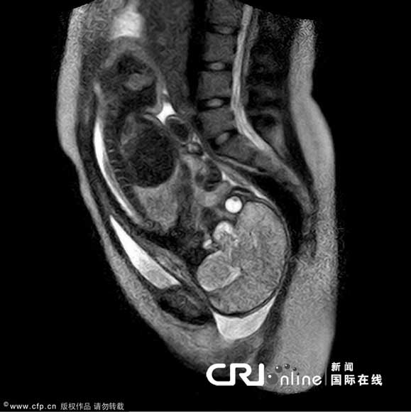 做核磁共振要脱内衣吗(3)