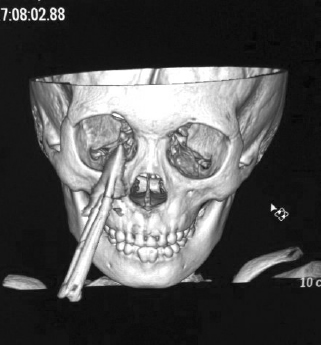 医院拍摄的ct三维图显示:剪刀刀尖深及眼眶,造成眼眶骨折.